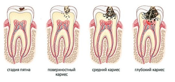 Стадии кариозного пятна