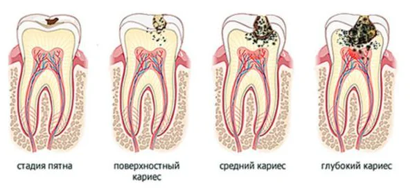 Стадии кариозного пятна
