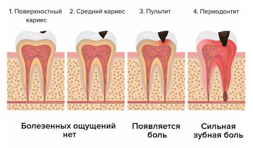 Схема развития кариеса до пульпита и периодонтита