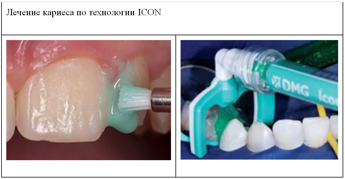 лечение кариеса по технологии ICON