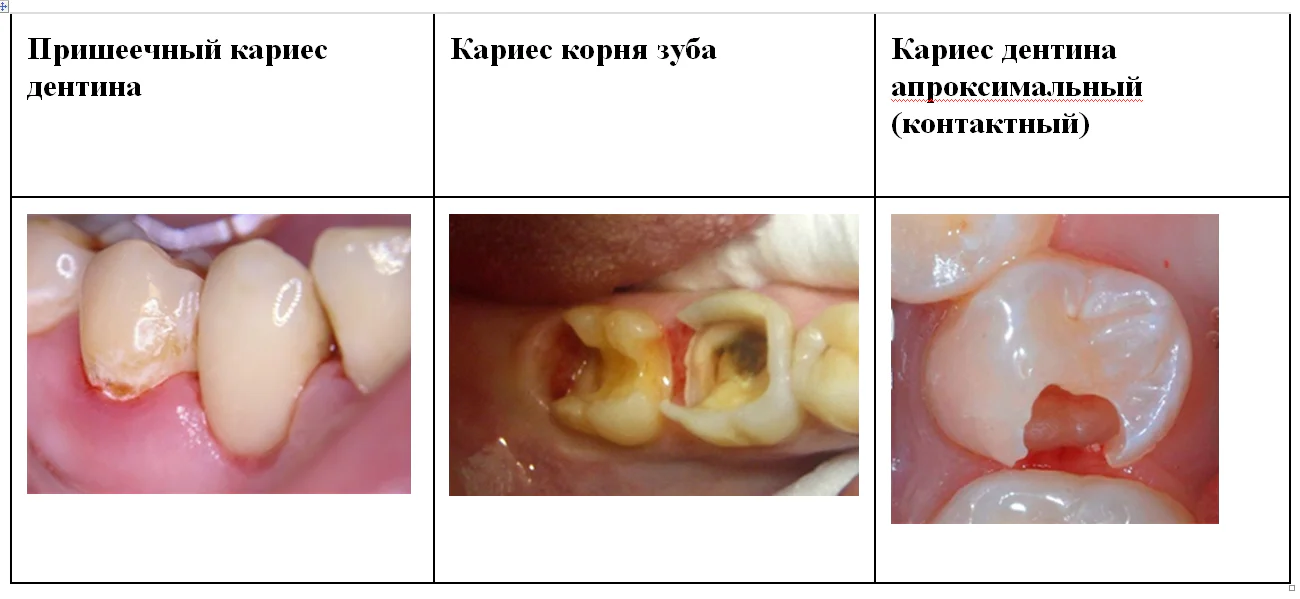 виды кариеса