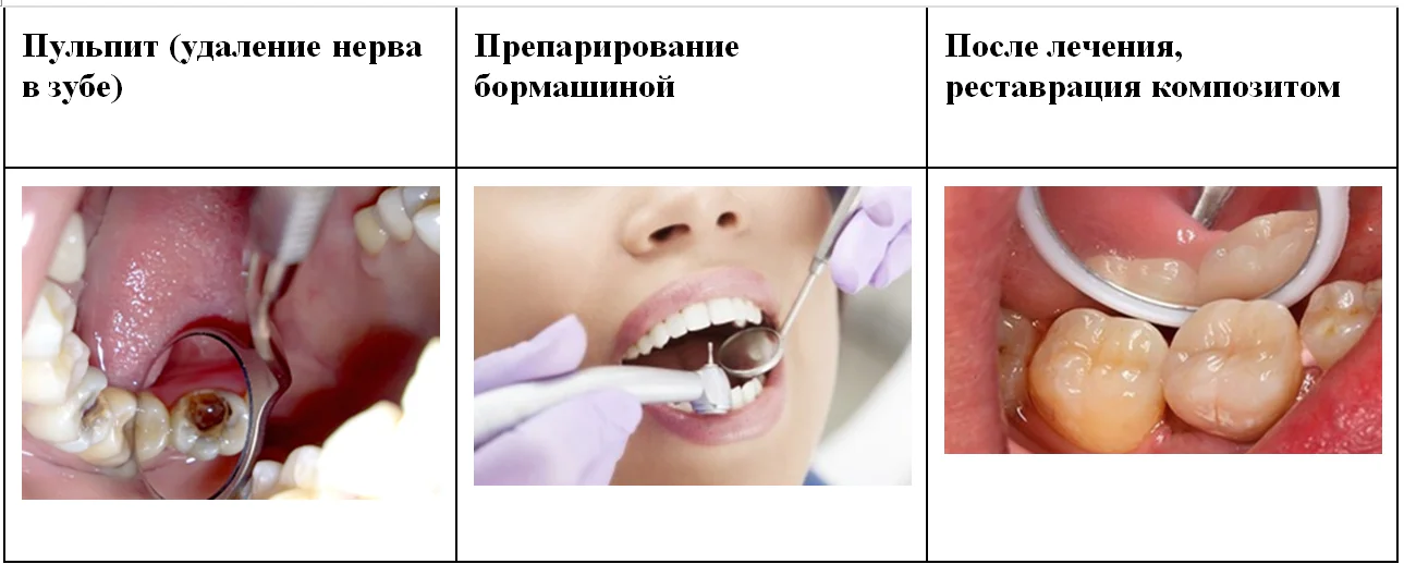 этапы лечение кариеса