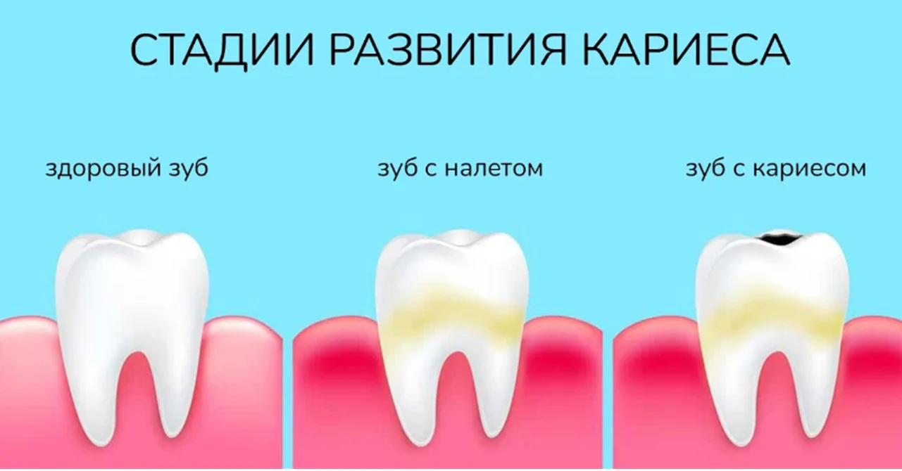 Стадии развития кариеса