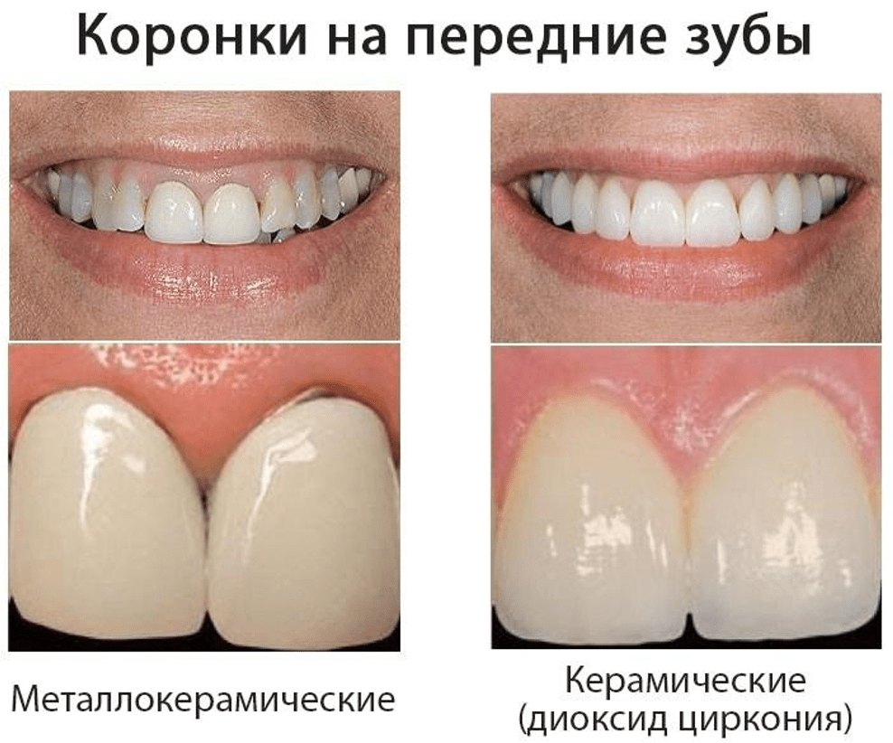 Коронки на передние зубы
